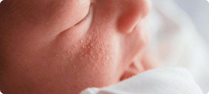Неонатальное акне