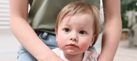 Профилактика аллергии: так ли это дорого, как думают родители?